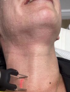cool peel co2 laser treatment on the neck