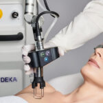 deka laser treatment