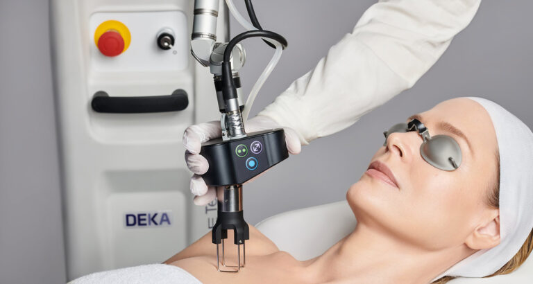 deka laser treatment