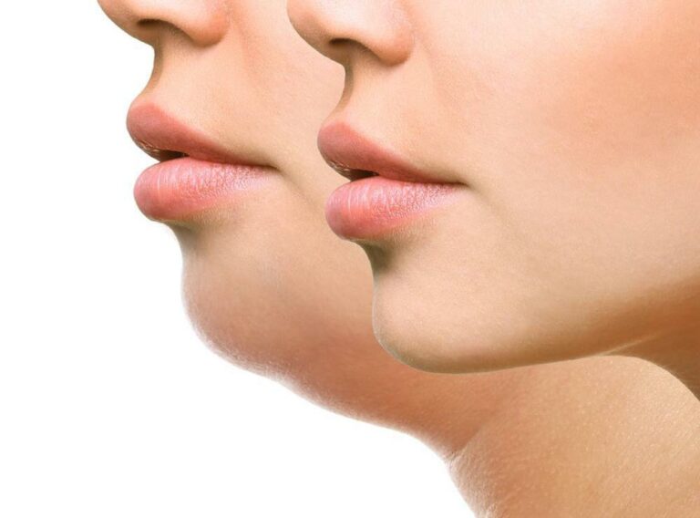 Sculpted elegance. Best treatments for jawline contouring