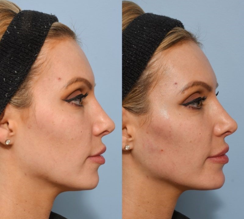 Before-and-after-jawline dermal filler Los Angeles