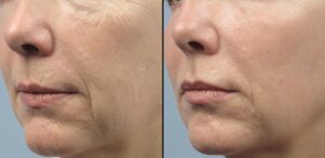 Morpheus8 for fine lines and wrinkles treatment Los Angeles