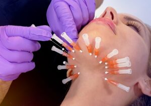 PDO Thread treatment for neck lift Los Angeles 