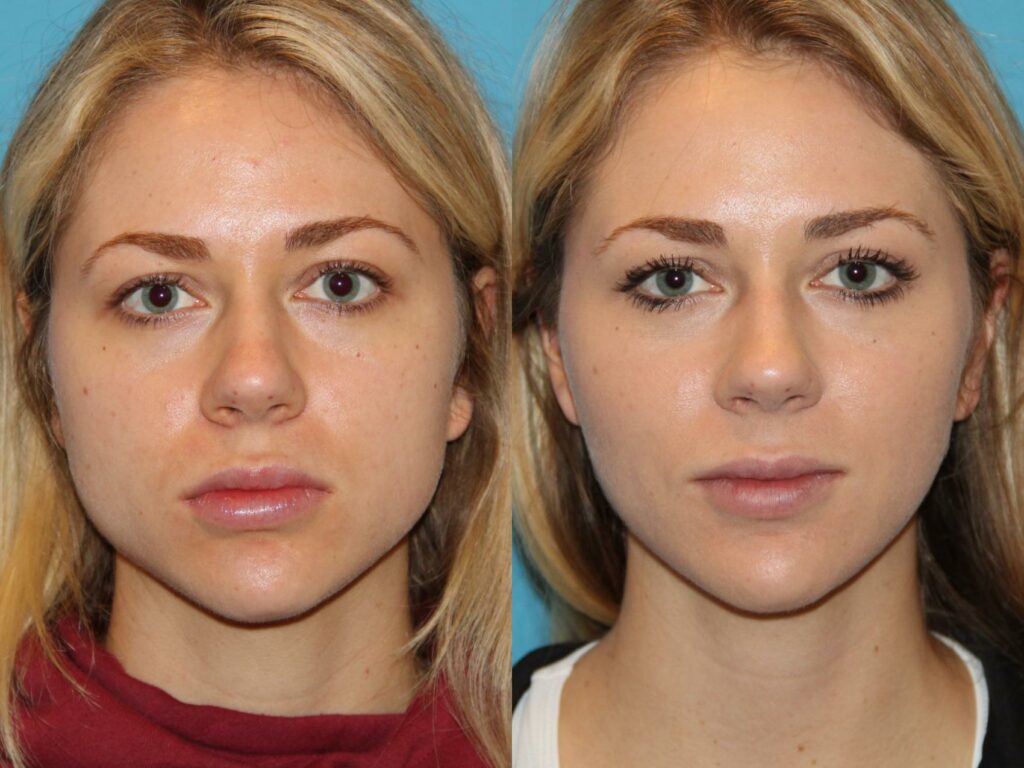 contour your jawline with Botox & Dysport Los Angeles