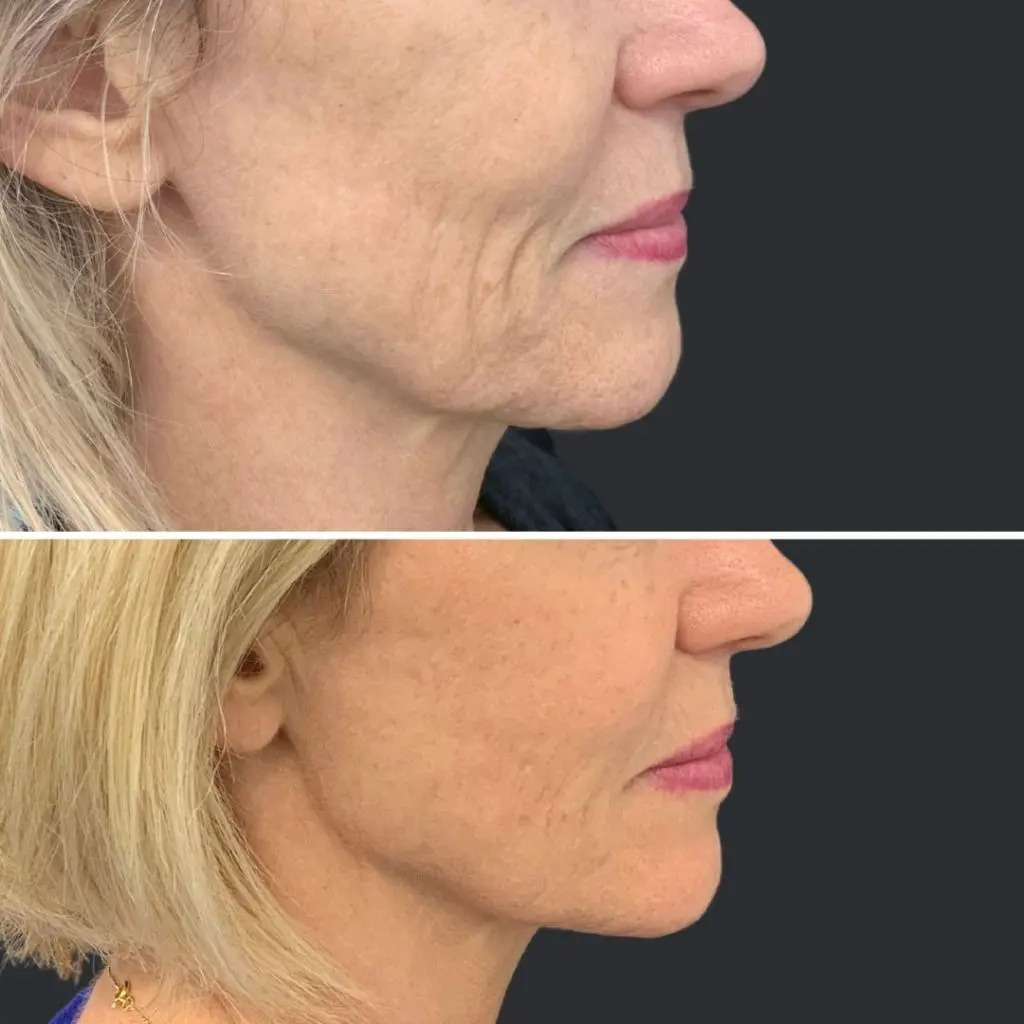 dermal fillers for double chin Los Angeles