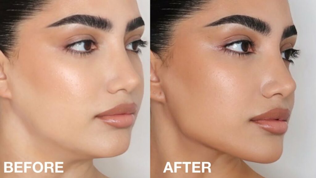 jawline contouring before-after Los Angeles