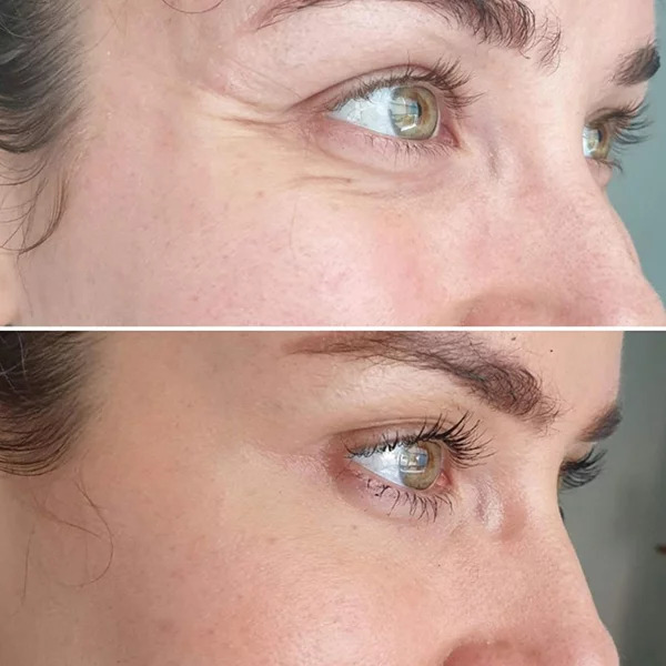 Botox for minimizing facial wrinkles before- after Los Angeles