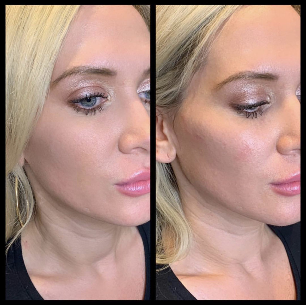 Cheek augmentation before-after Los Angeles