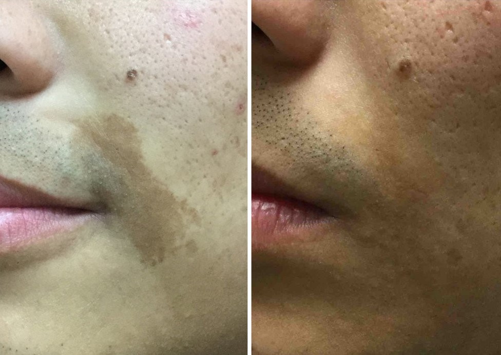 Lumecca IPL for cafe-au-lait spots removal before-after Los Angeles