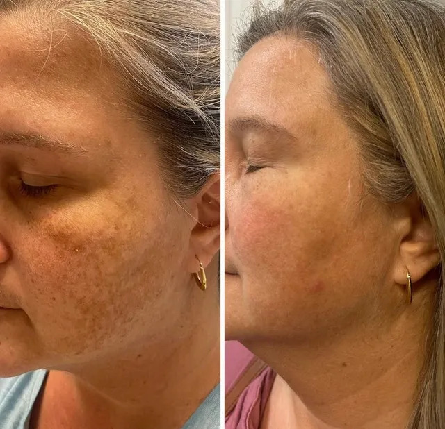 Lumecca IPL treatment before-after Los Angeles