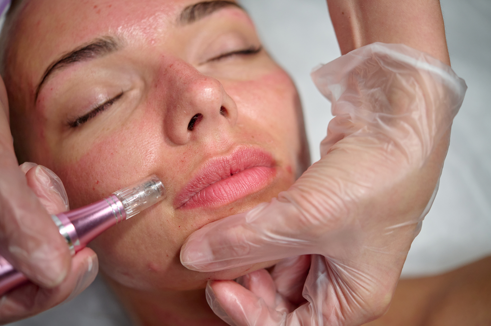 Microneedling for a smooth face Los Angeles