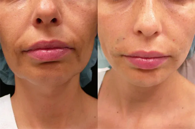 Morpheus8 treatment for tightening skin Los Angeles