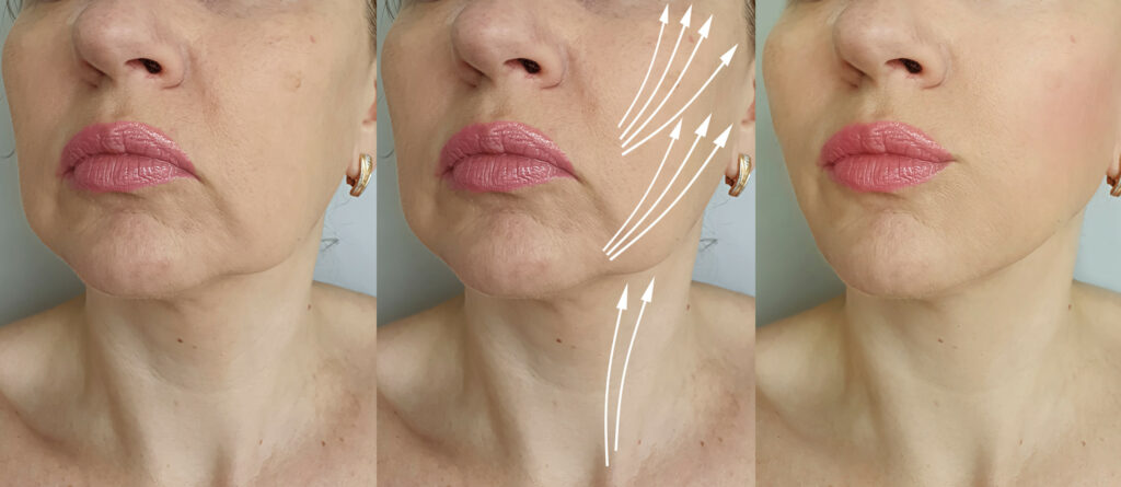 PDO threads for sagging cheeks before-after Los Angeles