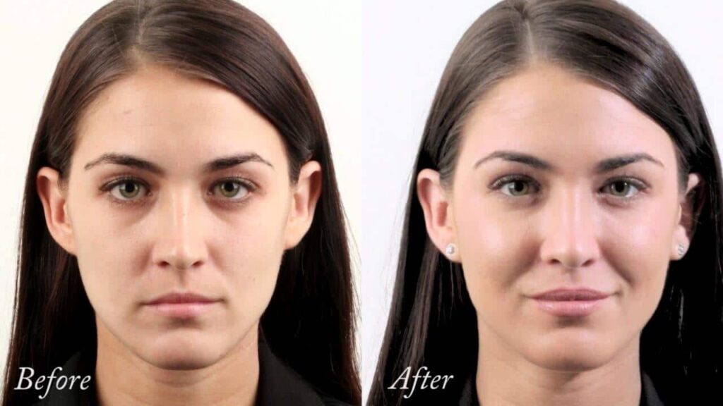 enhance cheek volume with fillers Los Angeles