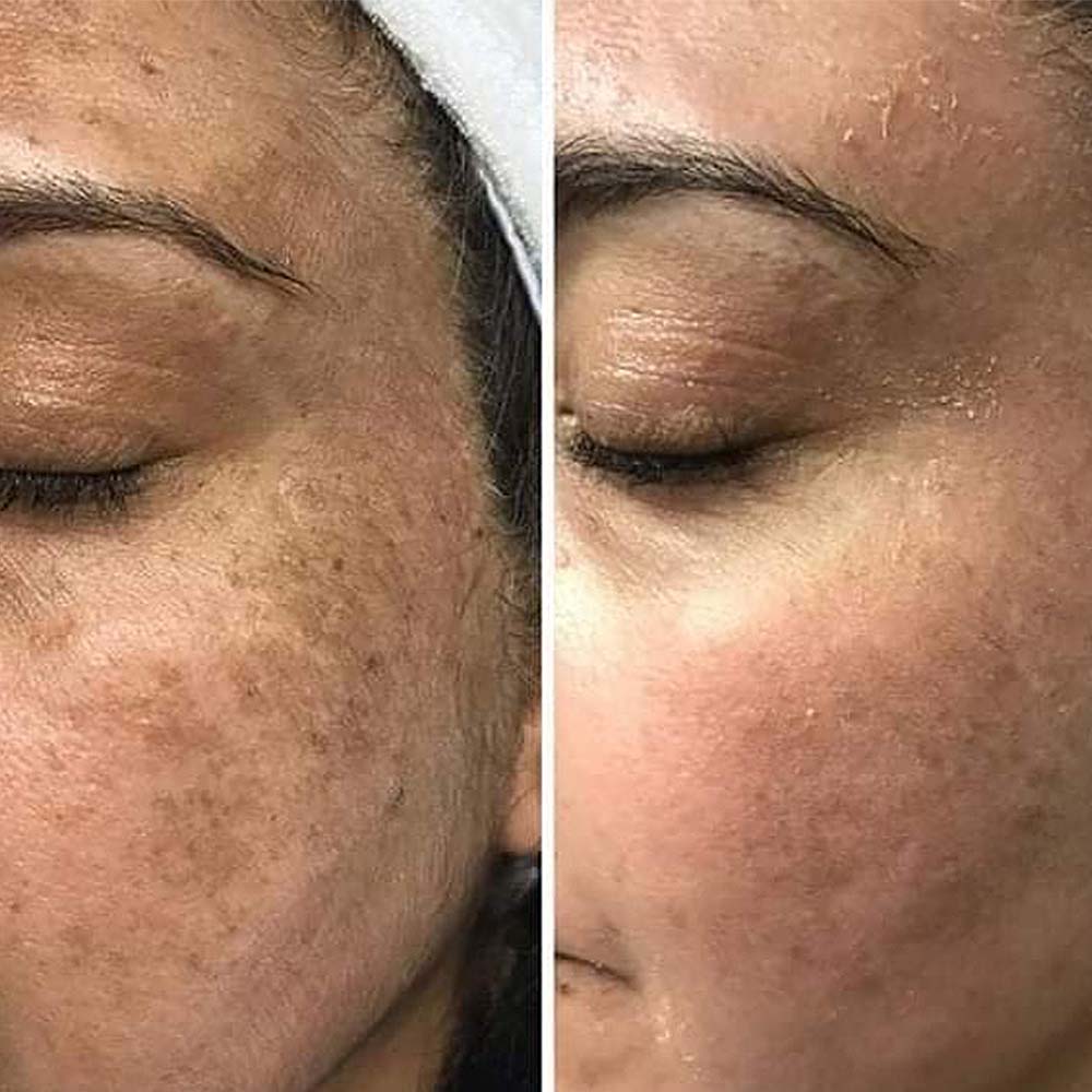 Chemical peels for hyperpigmentation Los Angeles
