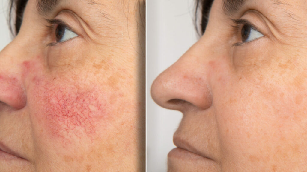 chemical peels for rosacea Los Angeles