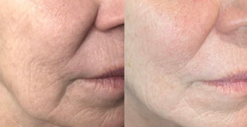 CoolPeel skin resurfacing treatment Los Angeles