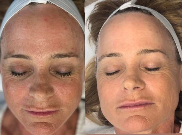 Diamond Glow facial before-after Los Angeles