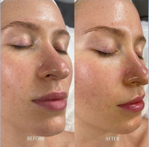 Diamond Glow facial before-after Los Angeles