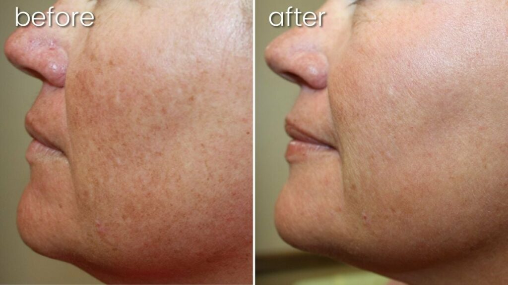 Lumecca IPL before-after Los Angeles