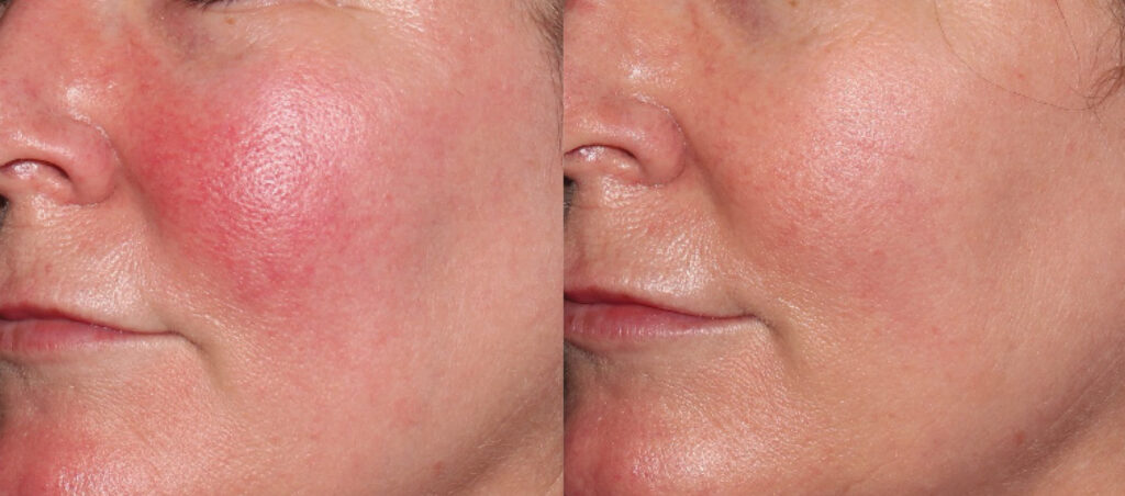 Lumecca IPL treatment for face redness Los Angeles