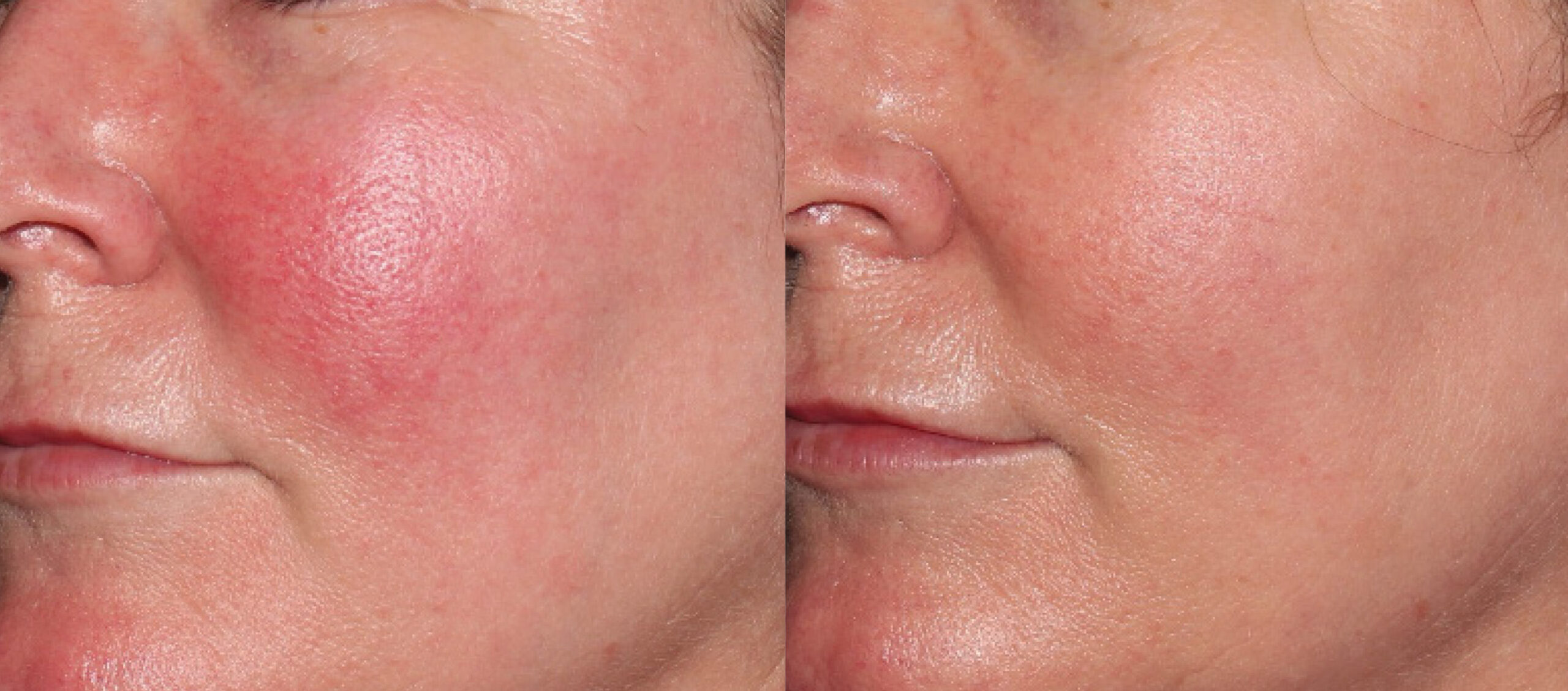 From red to radiant. 5 best treatments for rosacea - Hush LA Medspa From red to radiant. 5 best treatments for rosacea - Hush LA Medspa