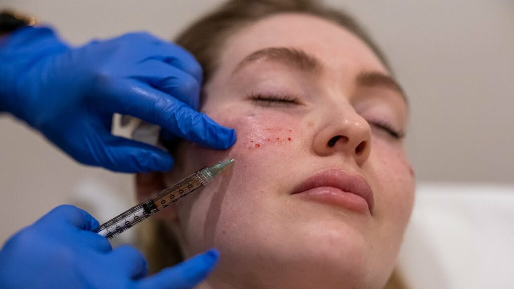 Platelet Rich Plasma Therapy for collagen stimulation Los Angeles