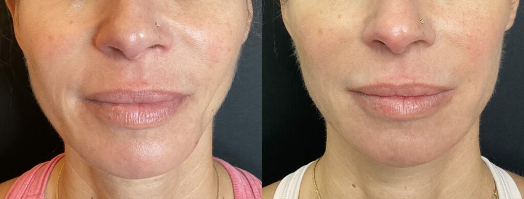 Sculptra injectable treatment before-after Los Angeles
