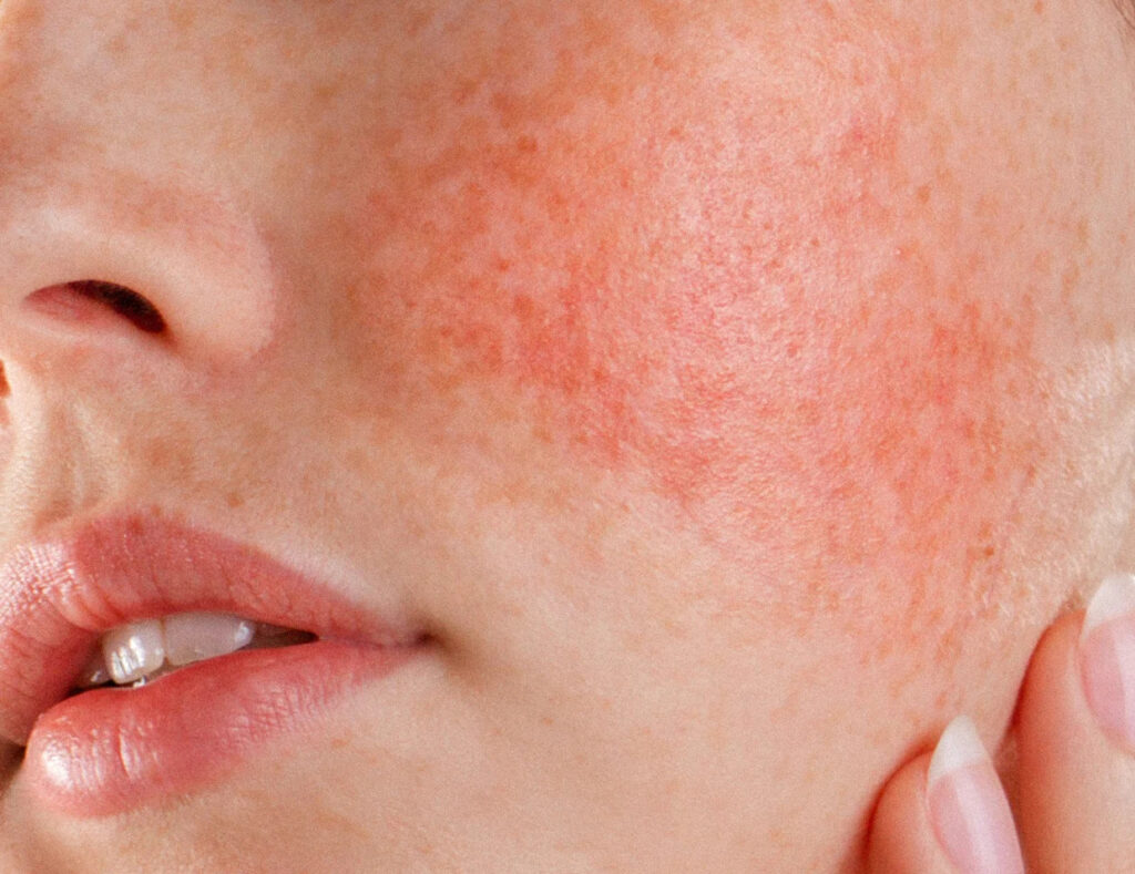 best treatments for rosacea Los Angeles