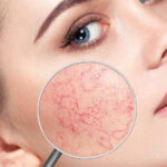 facial blood vessels treatment Los Angeles