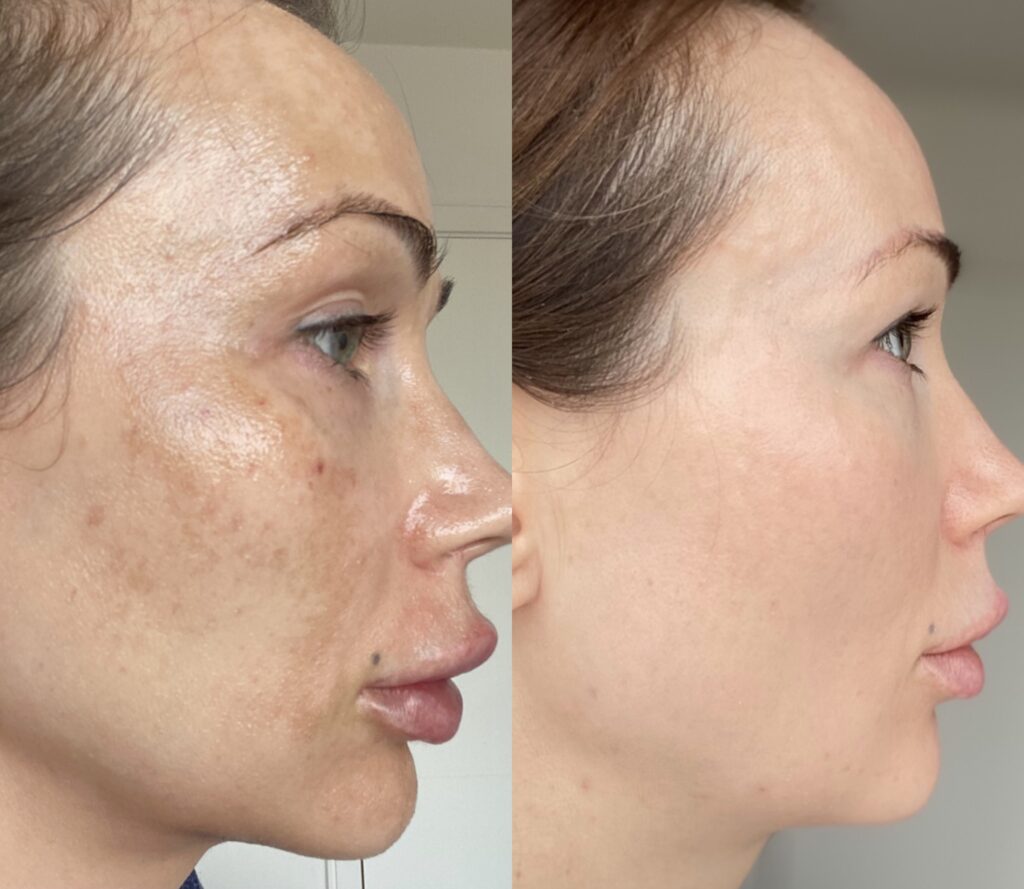 remove pigmentation with Cosmelan peel Los Angeles