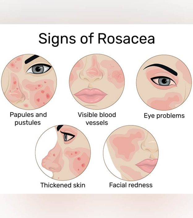 signs of rosacea Los Angeles