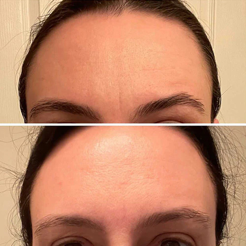 Juvéderm anti-wrinkle injection Los Angeles