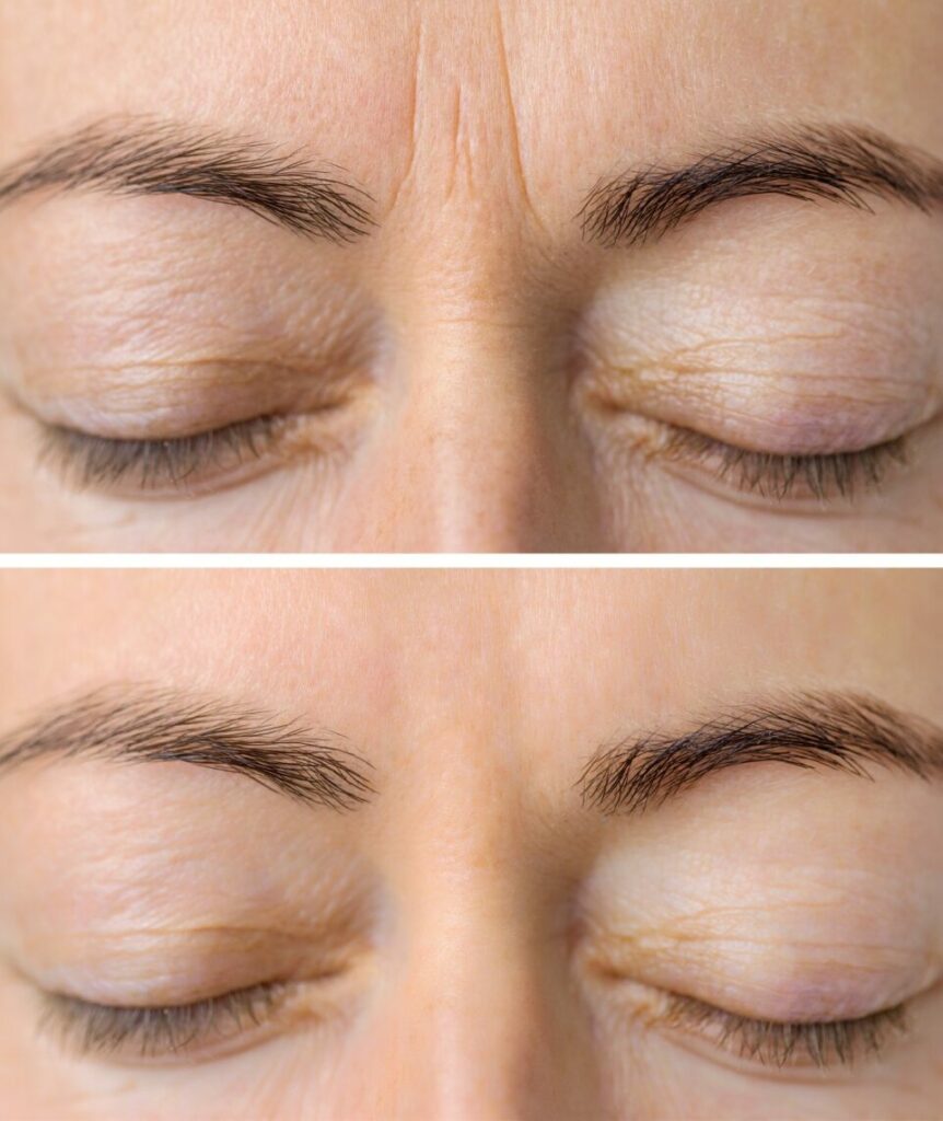 Restylane injection for forehead wrinkles Los Angeles