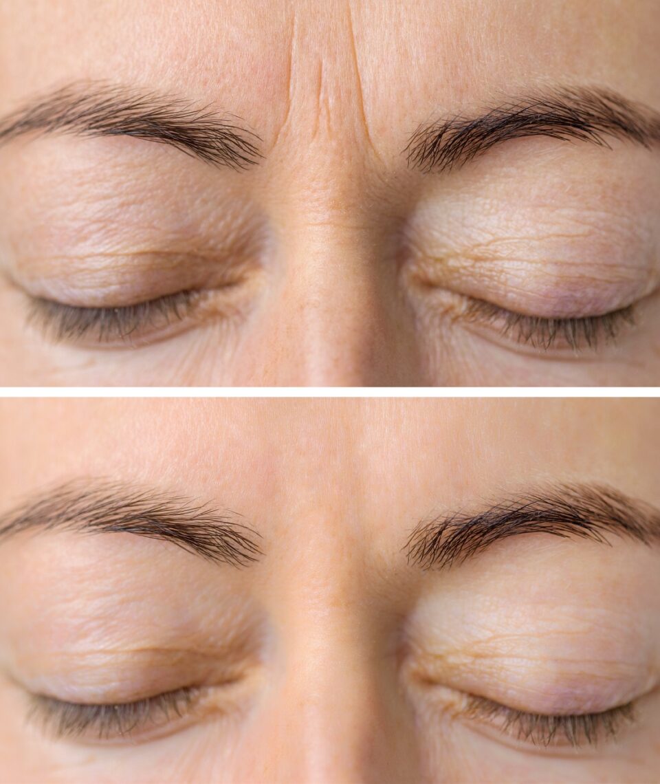Restylane injection for forehead wrinkles Los Angeles