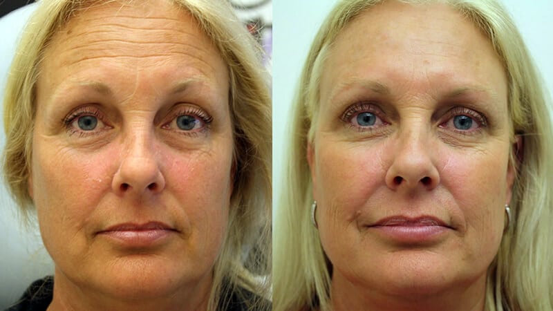 Sculptra collagen stimulation injection before-after Los Angeles