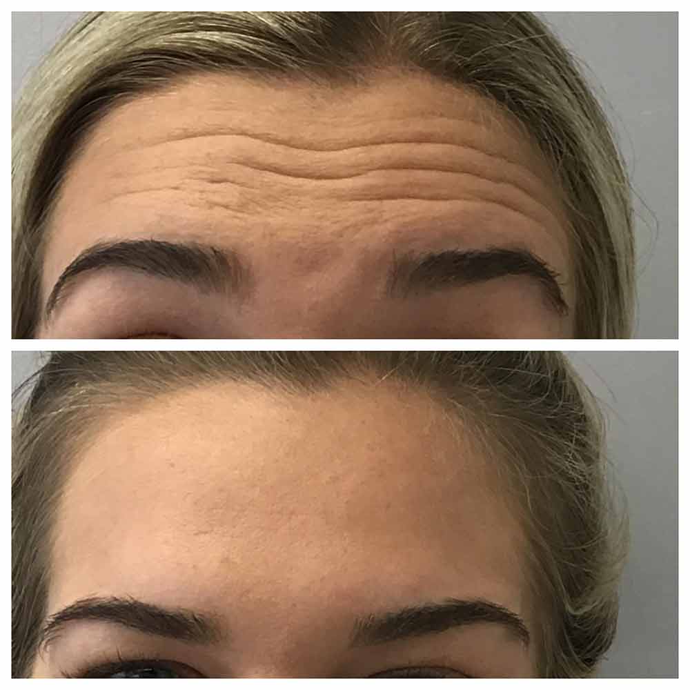 botox for wrinkles before- after Los Angeles