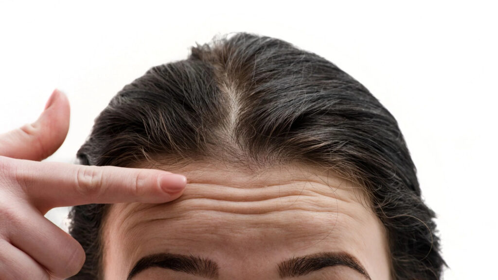 forehead lines treatment Los Angeles