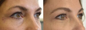 Tear Trough Treatment Los Angeles 