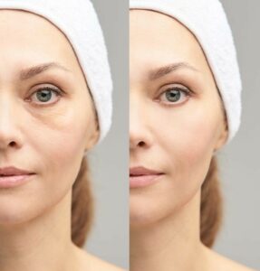 how to get rid of under-eye hollows Los Angeles