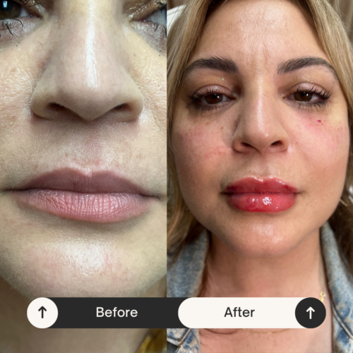 Lip Injections Before & After - Hush LA Medspa