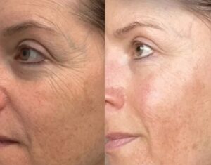The Vamp facial treatment Los Angeles