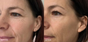 salmon sperm facial treatment before-after Los Angeles