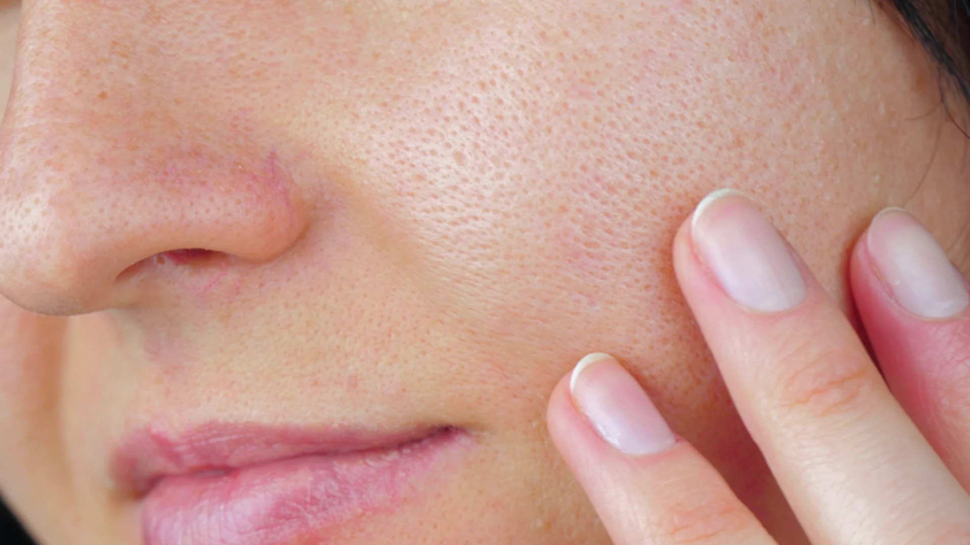 Causes of dilated pores Los Angeles
