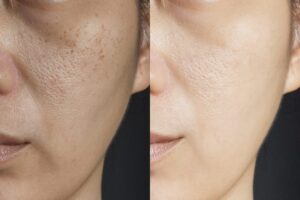 Chemical Peels for large pores Los Angeles 