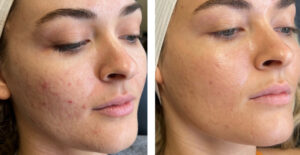 Cool Peel for dilated pores before-after Los Angeles 