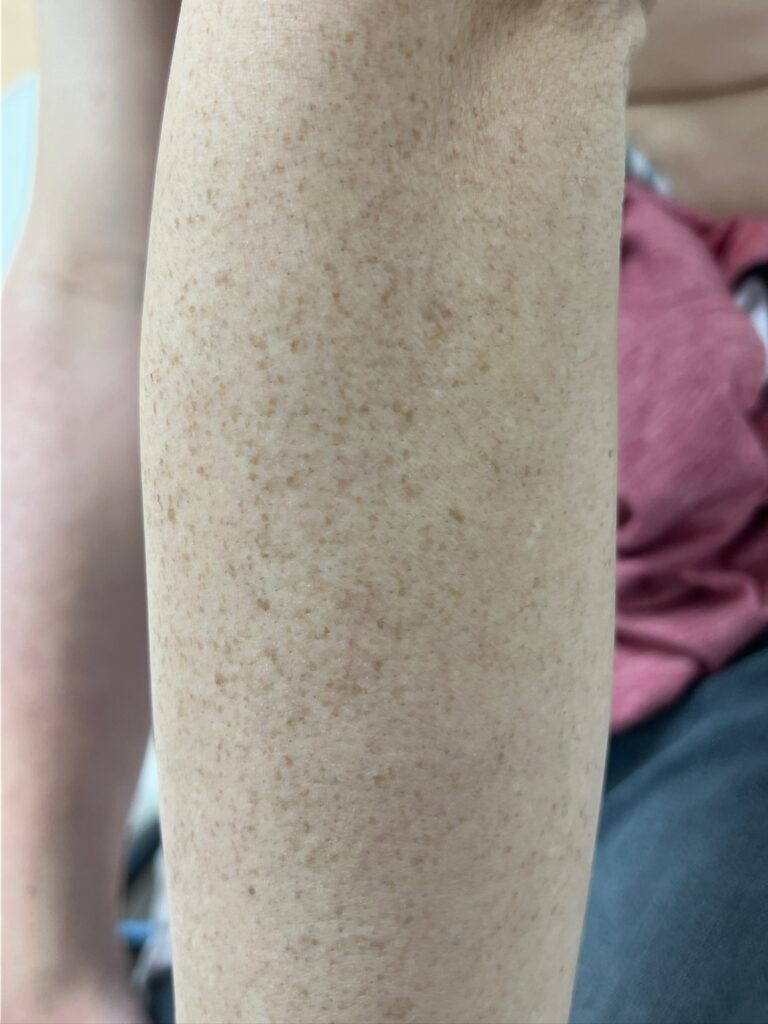 freckle removal Los Angeles