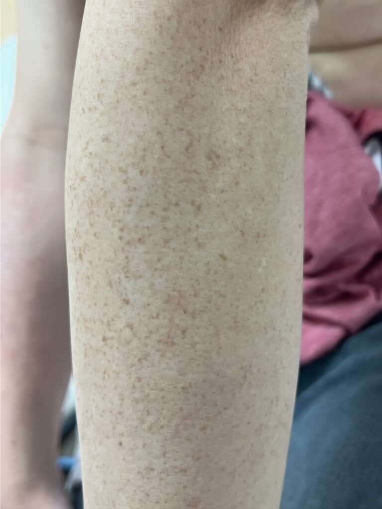 freckle removal on arms