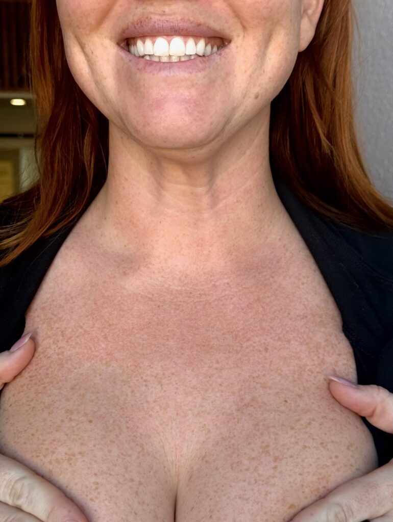 freckle removal on chest Los Angeles