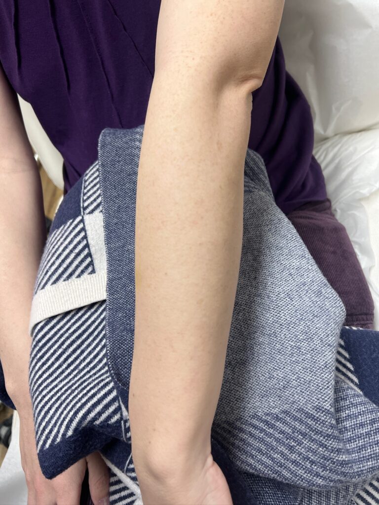 freckle removal after Los Angeles